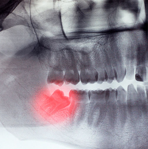 Wisdom tooth extraction - After Orthodontics